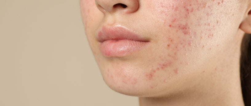 Caring For Your Complexion Through Breakouts