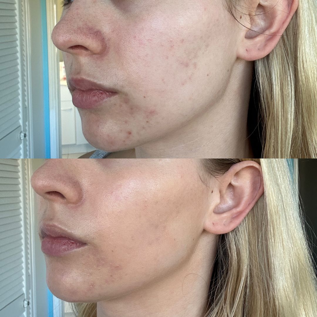 2 images of a female face stacked on top of each other. The top one shows the cheek and jaw on an angle with no makeup and acne scars can be seen. The one below is after Burleigh Minerals Earth Cream Tinted Moisturiser has been applied and the skin is now a more even tone with sheer coverage of those scars.